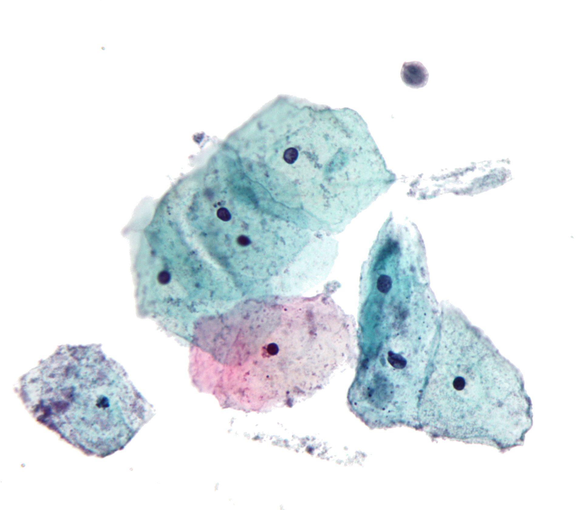 <p>Pap With <em>Trichomonas Vaginalis.</em></p>