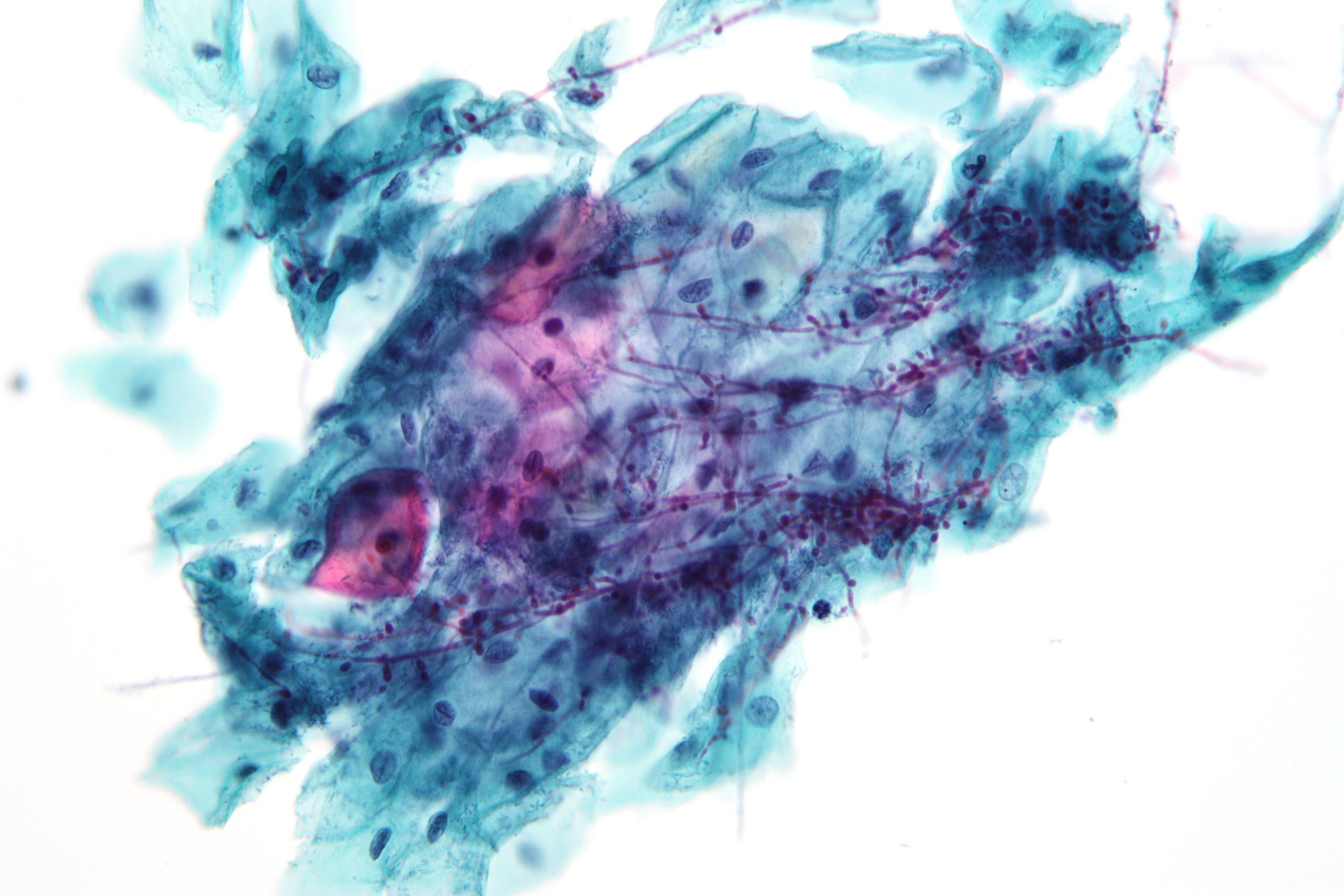 <p>Pap With<em>&nbsp;Candida.</em></p>