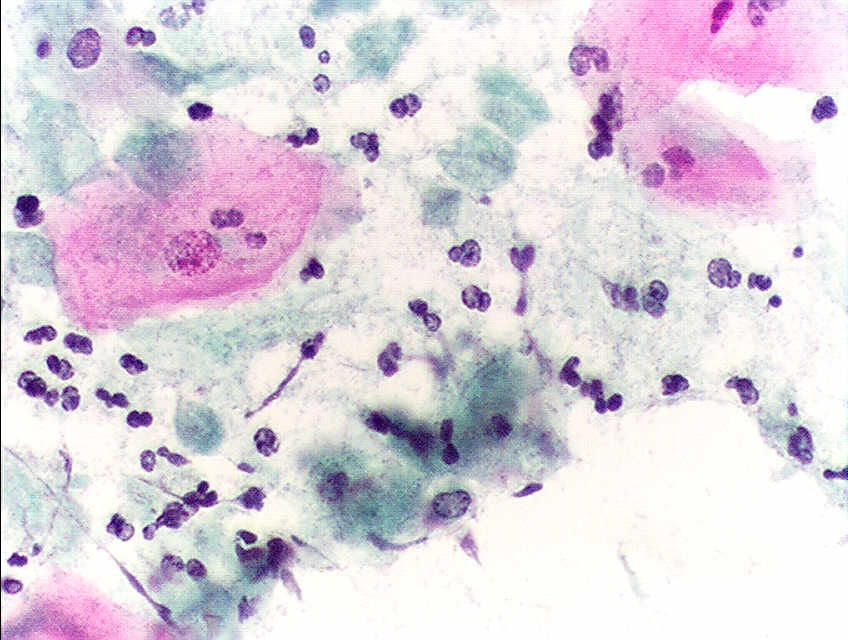 <p>Pap Test With<em> Trichomonas Vaginalis.</em></p>
