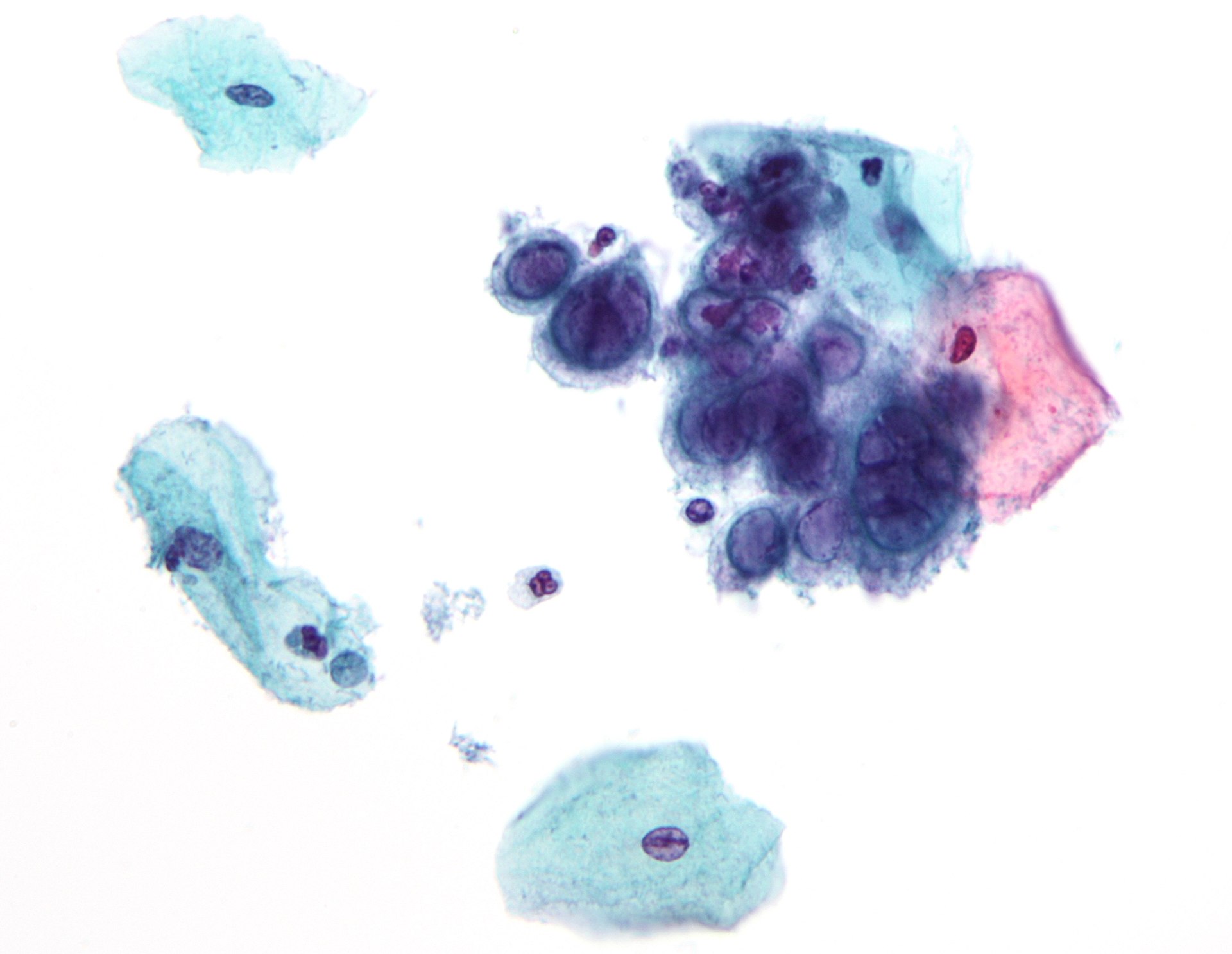 <p>Pap With Herpes Simplex Virus.</p>