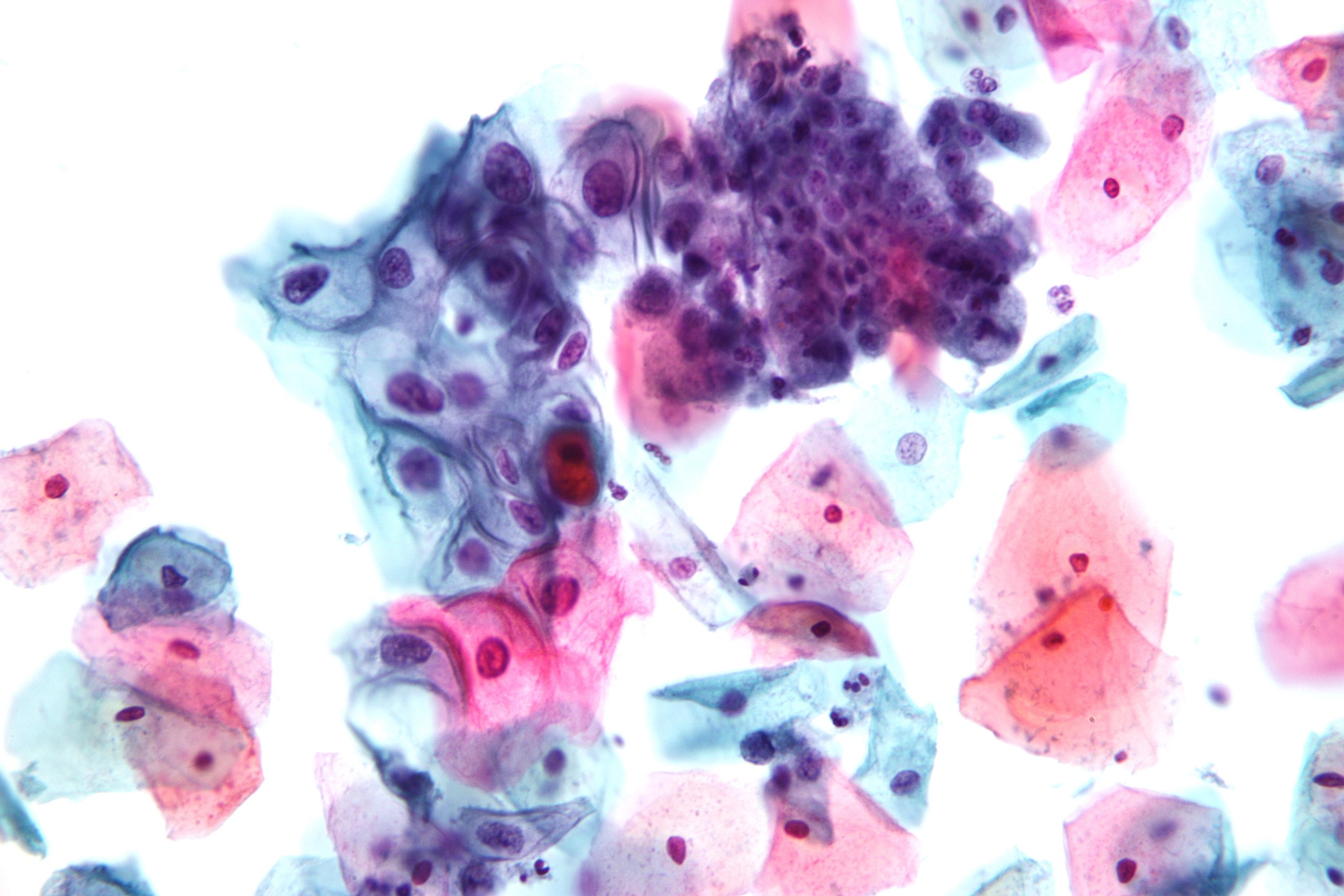 <p>Pap With Low-Grade Squamous Intraepithelial Lesion and Benign Endocervical Cells.</p>