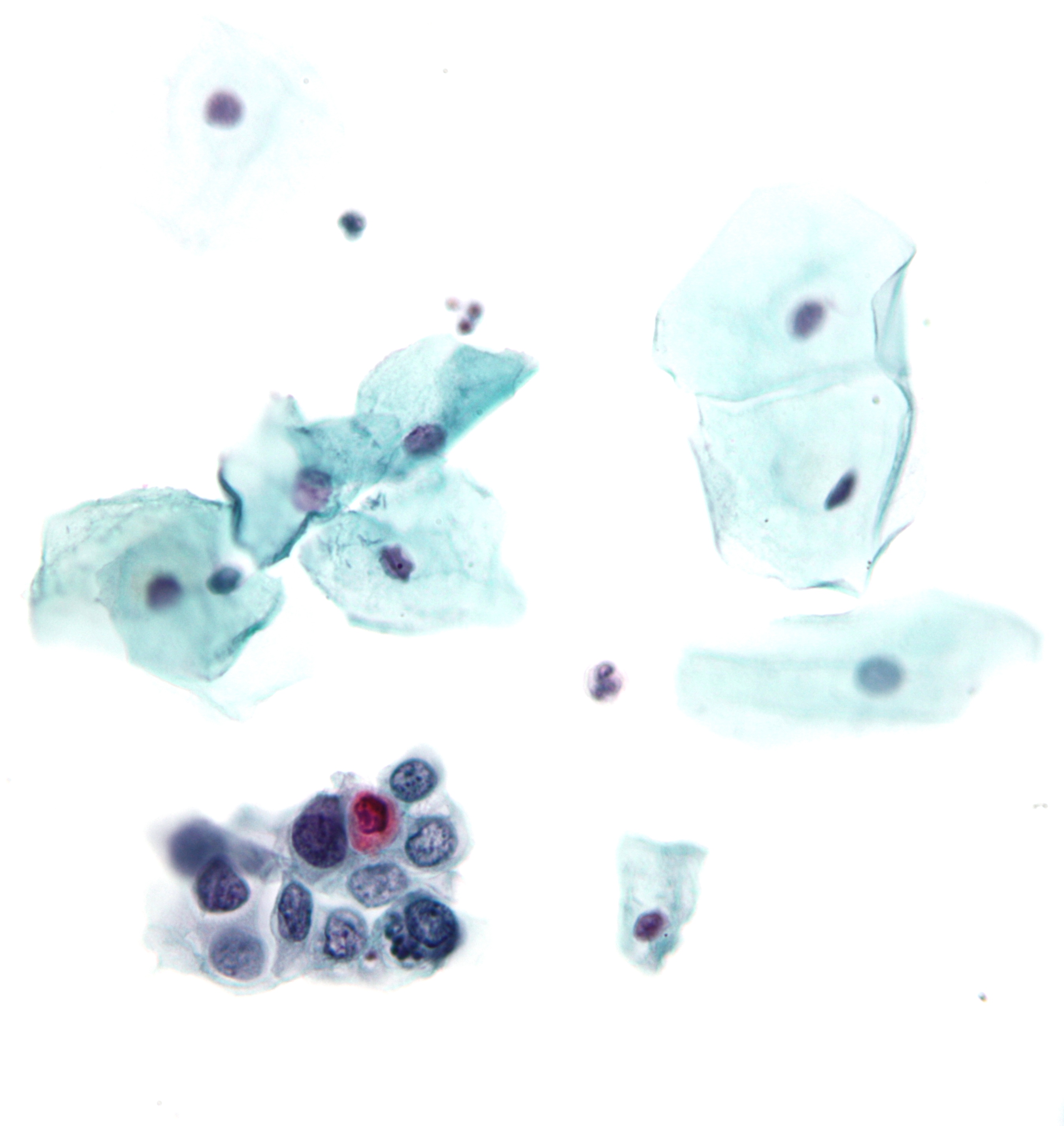<p>Pap With High-Grade Squamous Intraepithelial Lesion.</p>