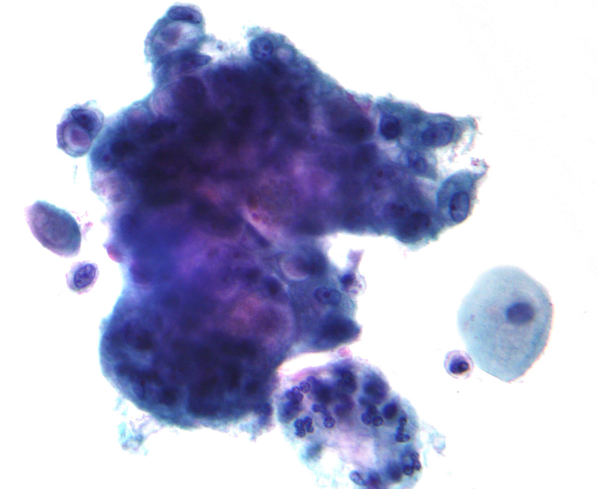 <p>Pap With Adenocarcinoma.</p>