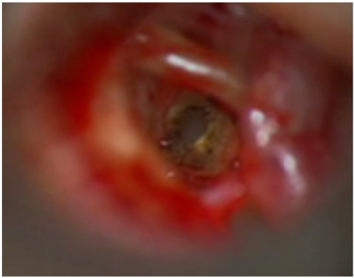 <p>Stapes Footplate Perforation by Fiber-Delivered Carbon Dioxide&nbsp;Laser