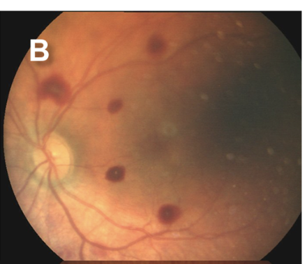 <p>Grade 2 Retinal Hemorrhage