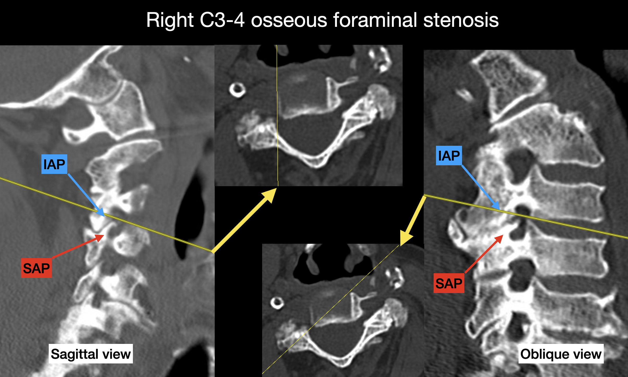 <p>Osseous Foraminal Stenosis