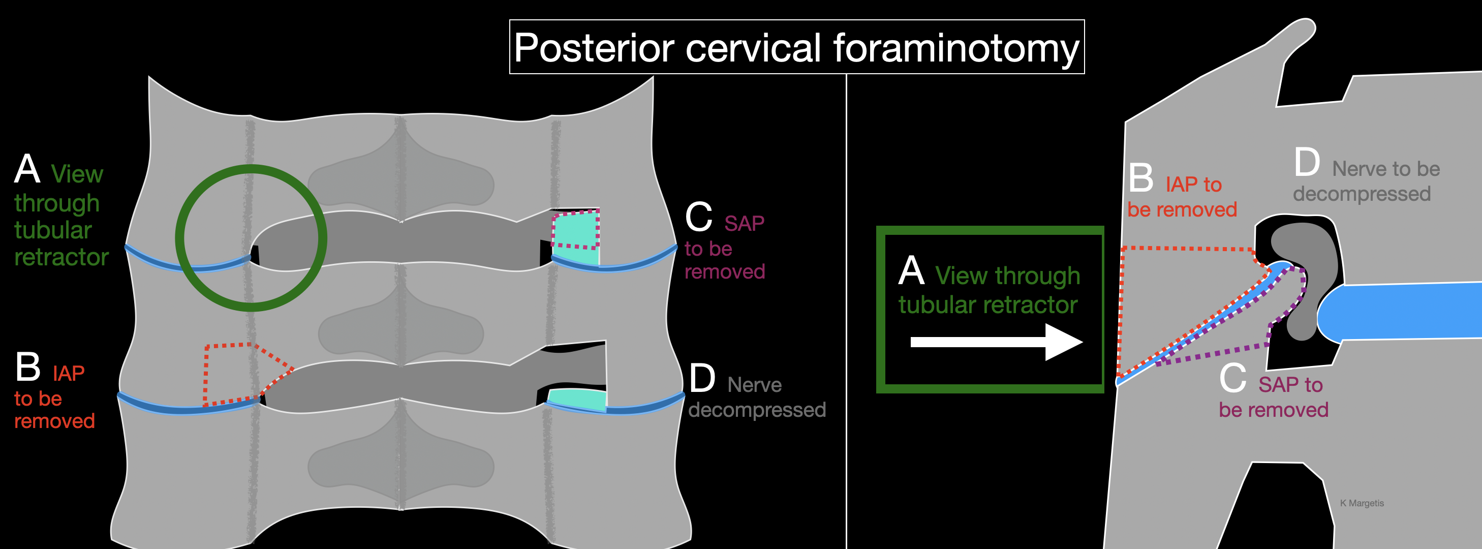 <p>Posterior Cervical Foraminotomy