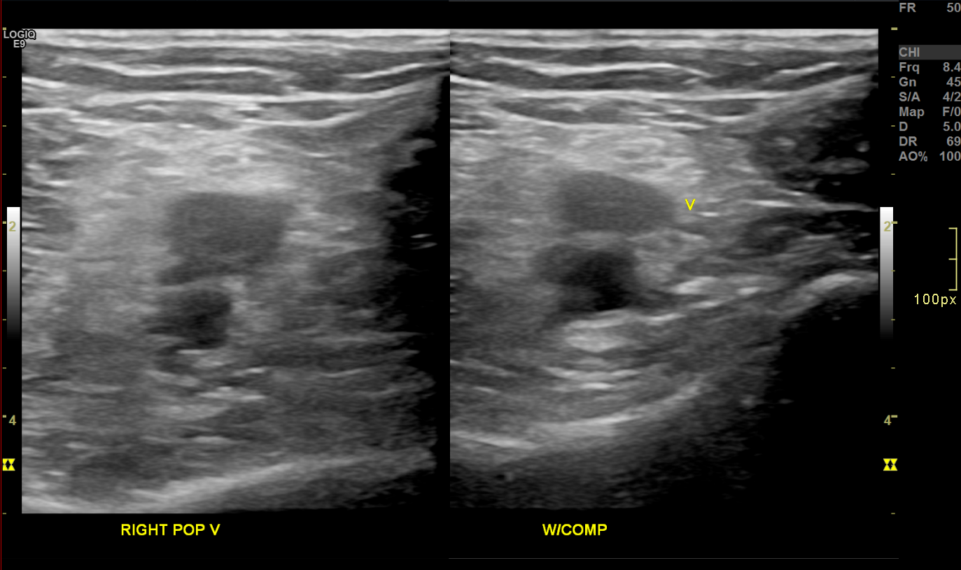 <p>Acute Deep Venous Thrombosis on Brightness Mode