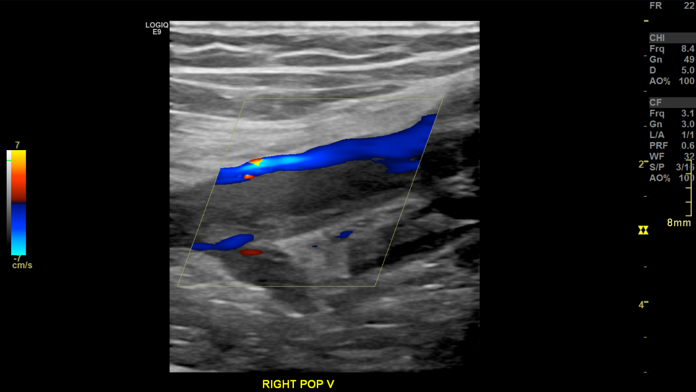 <p>Acute Deep Vein Thrombosis&nbsp;on Doppler Ultrasound, Longitudinal View