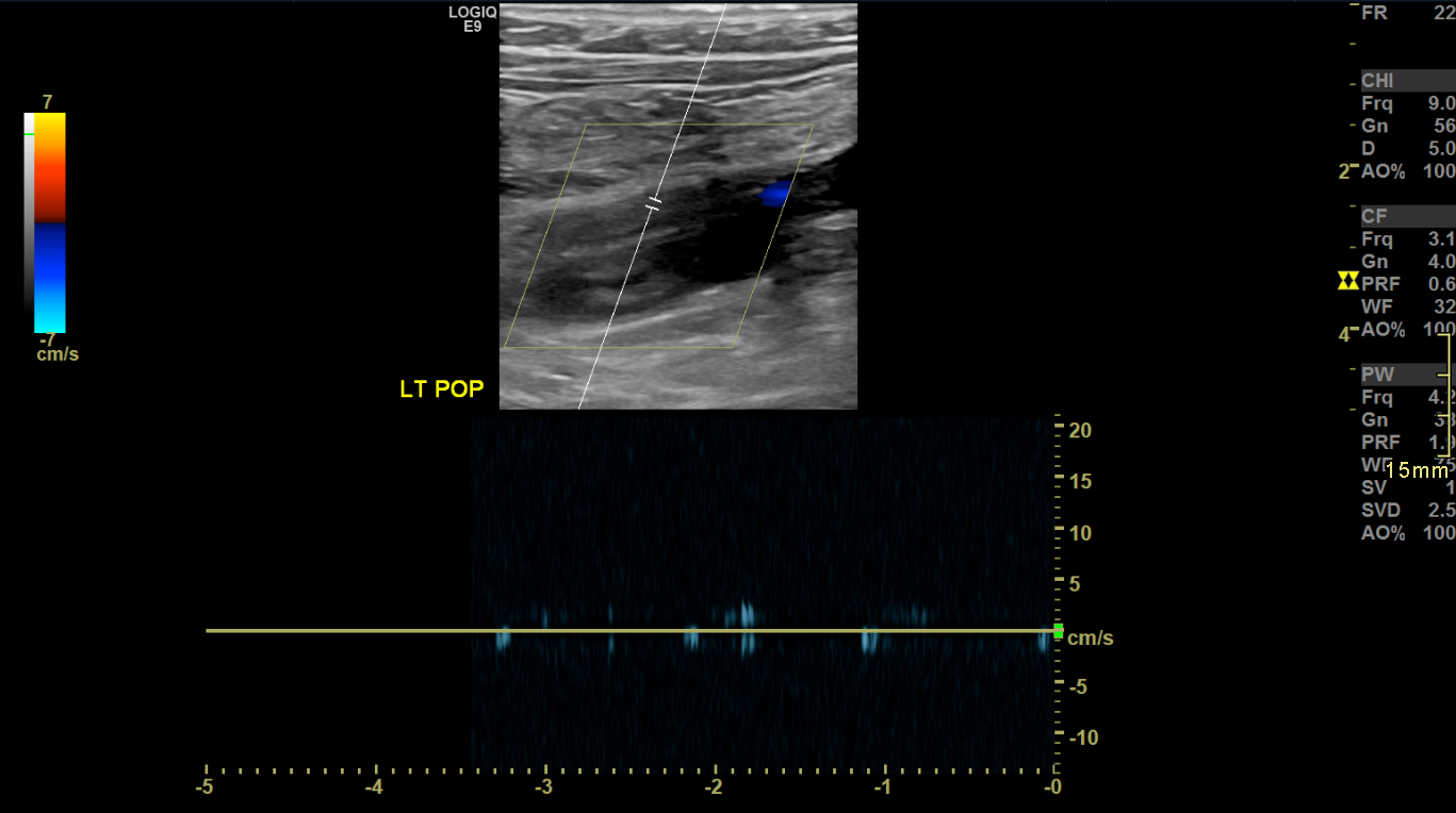 <p>Chronic Deep Vein Thrombosis on Brightness Mode with Spectral Doppler Imaging, Long View