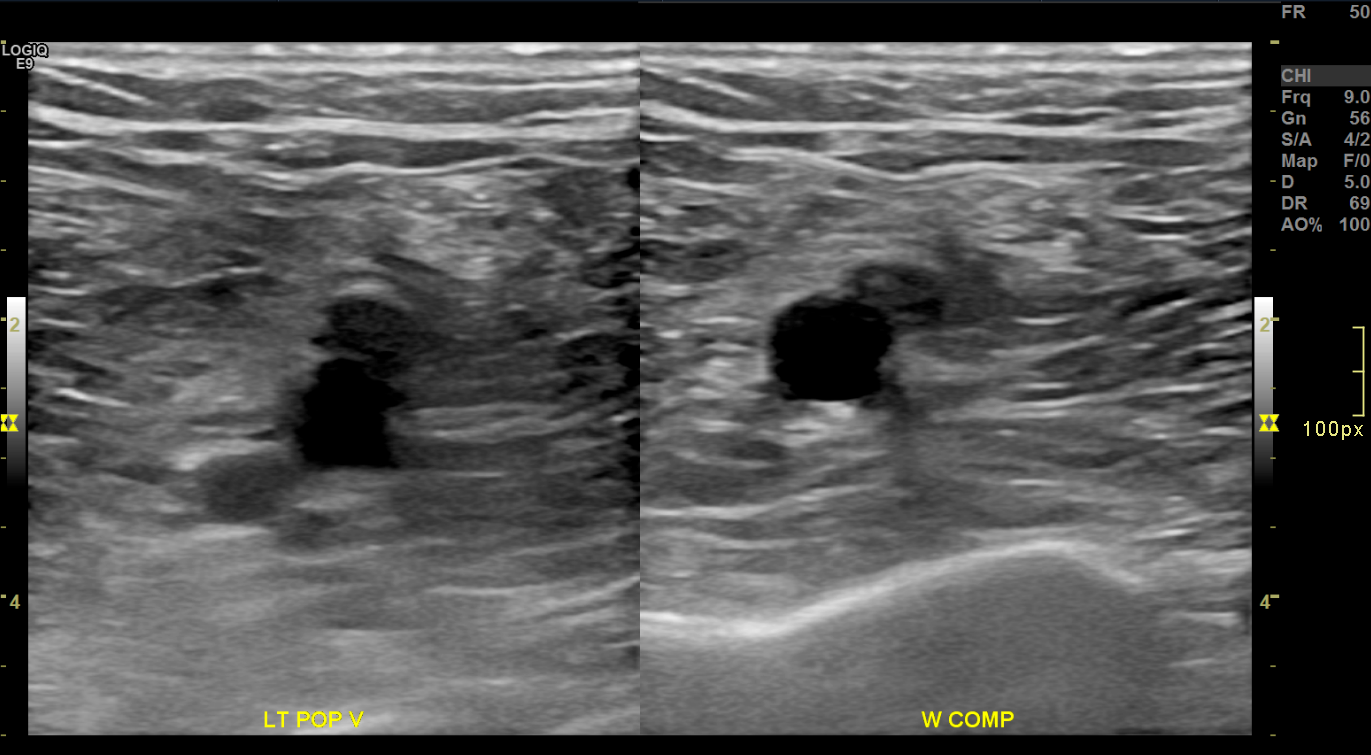 <p>Chronic Deep Venous Thrombosis on Brightness Mode