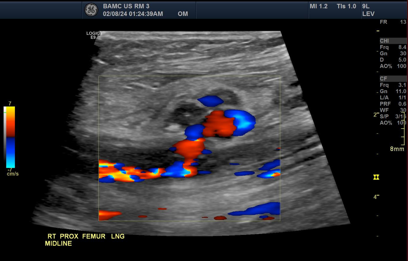 <p>Common Femoral Artery Pseudoaneurysm on Doppler Ultrasound, Long View