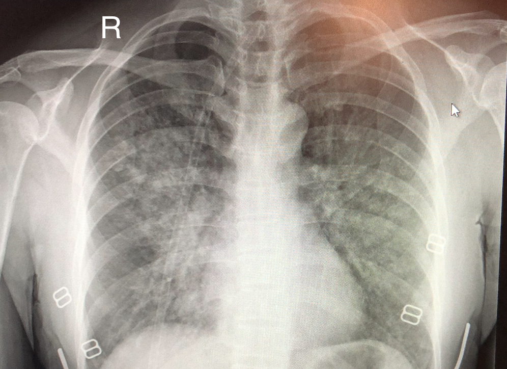 <p>High-Altitude Pulmonary Edema on Chest Radiography