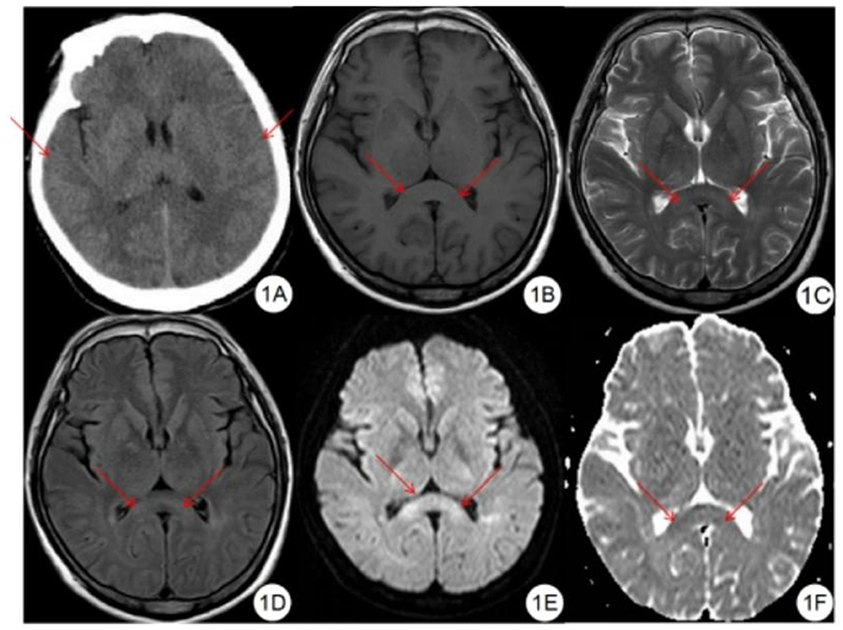 <p>Mild High-Altitude Cerebral Edema on Multimodal Imaging