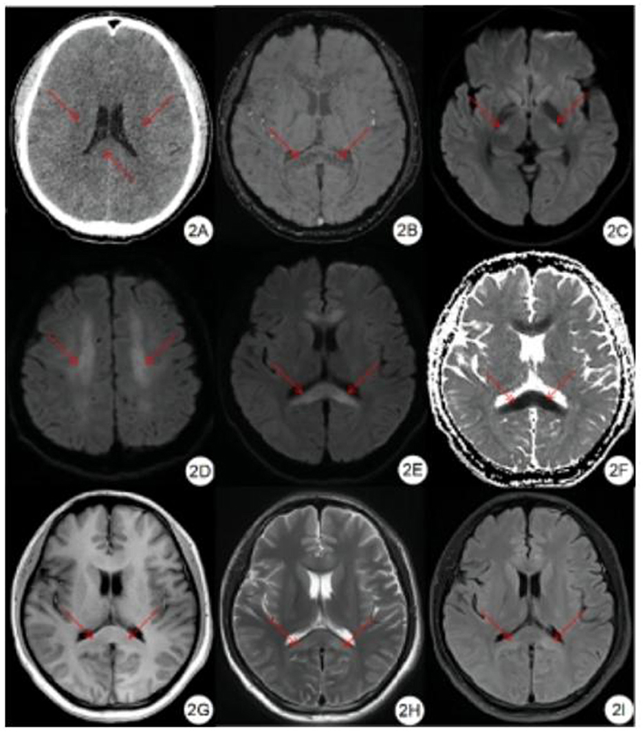 <p>Severe High-Altitude Cerebral Edema on Multimodal Imaging