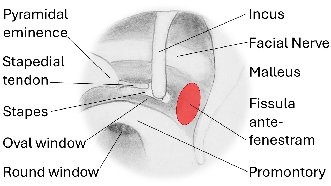 <p>View of the right middle ear via the external auditory canal, with the fissula antefenestram highlighted in red.</p>