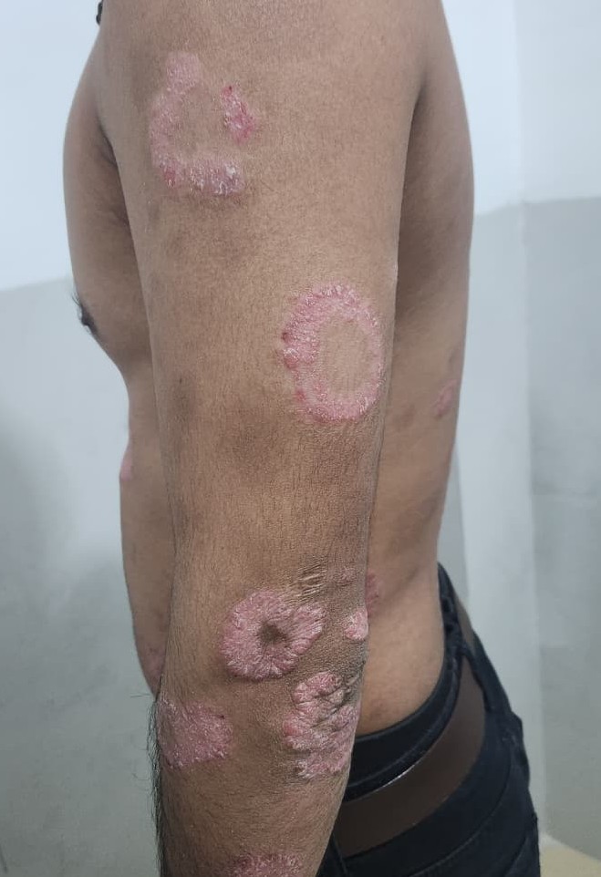 <p>Psoriasis: Annular Erythematous Plaques on the Arm