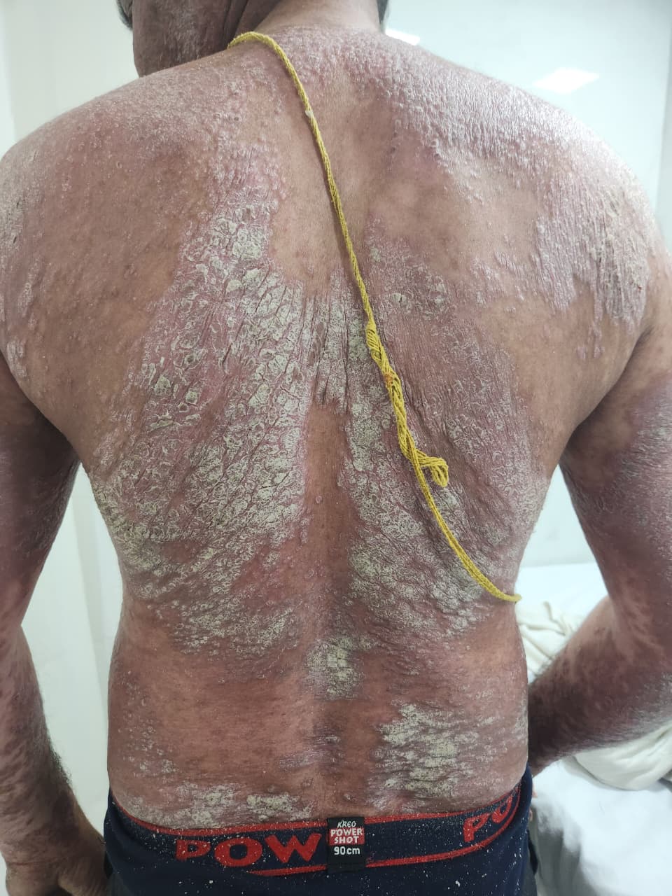 <p>Plaque Psoriasis: Multiple Erythematous Scaly Plaques Over the Back