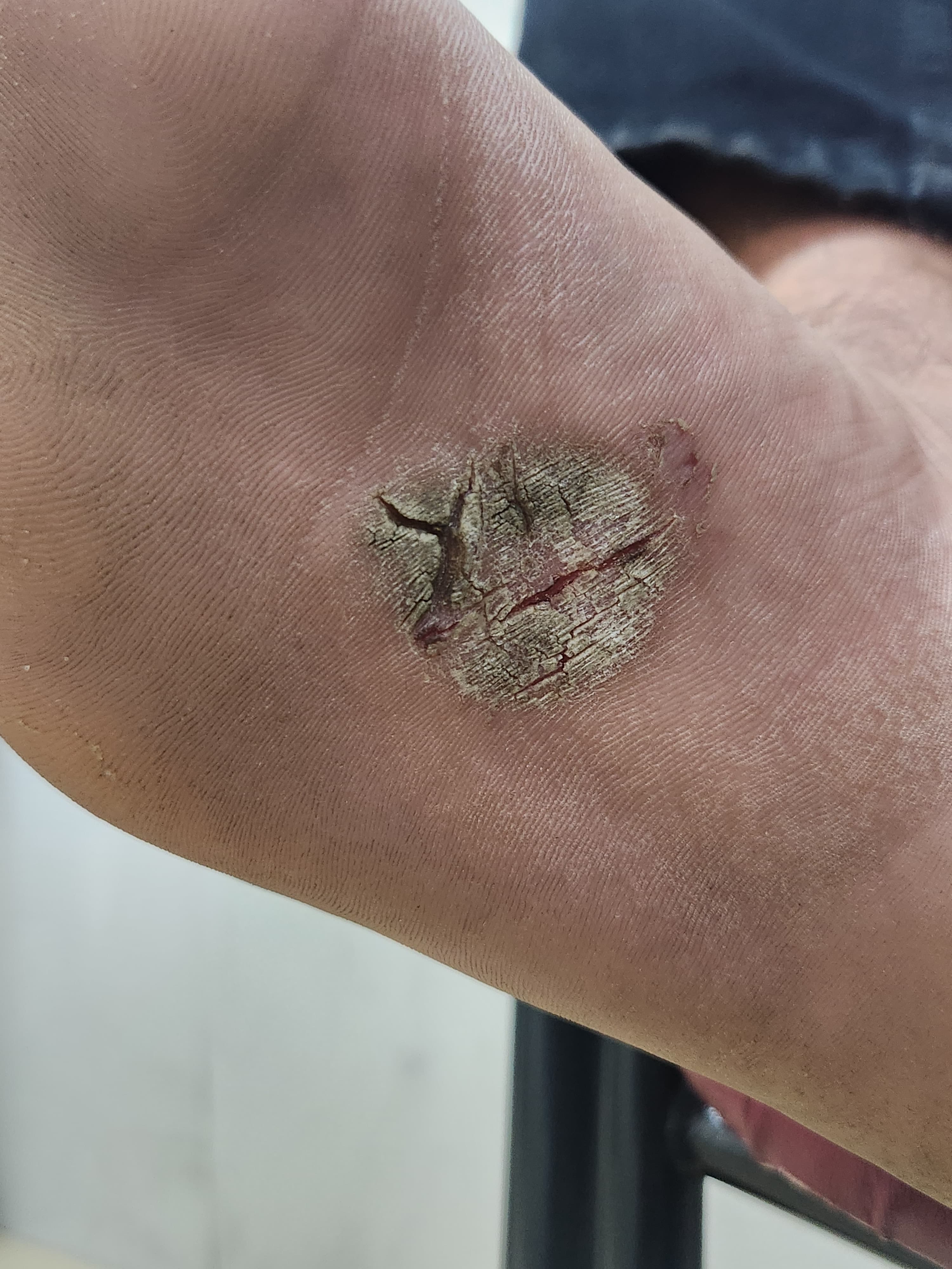 <p>Plantar Psoriasis: Isolated Hyperkeratotic Scaly Plaque With Fissuring Over the Sole
