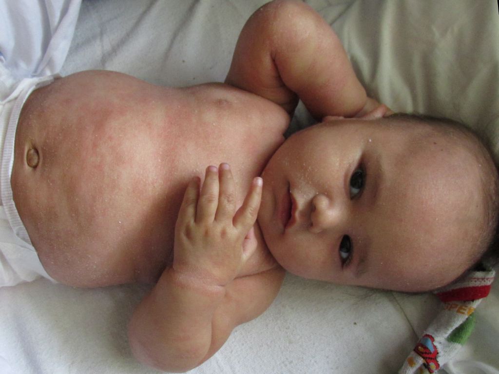 <p>Infantile Seborrhoeic Dermatitis</p>