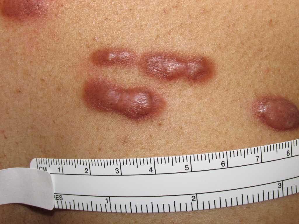 <p>Keloid Scars</p>