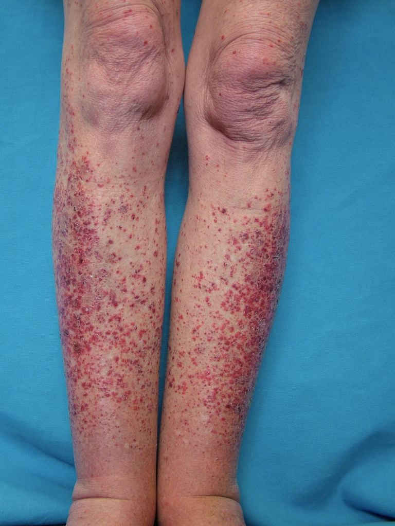 <p>Leukocytoclastic Vasculitis</p>