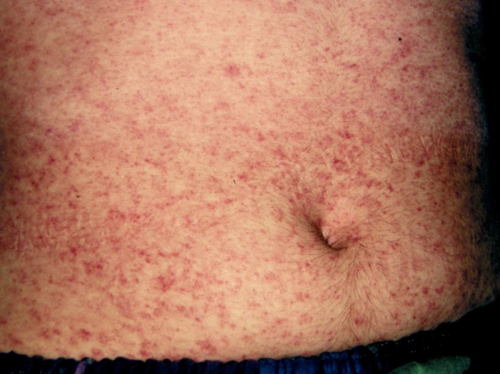 <p>Measles Infection. This image shows the characteristic rash seen in those with measles infection.</p>