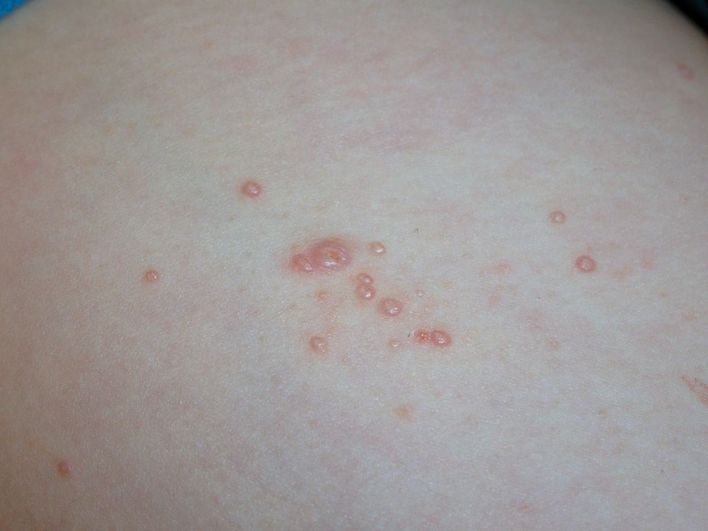 <p>Molluscum Contagiosum</p>