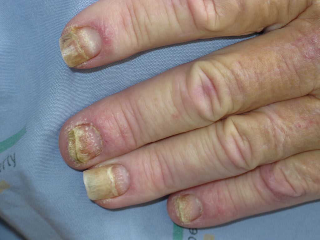 <p>Nail Psoriasis</p>