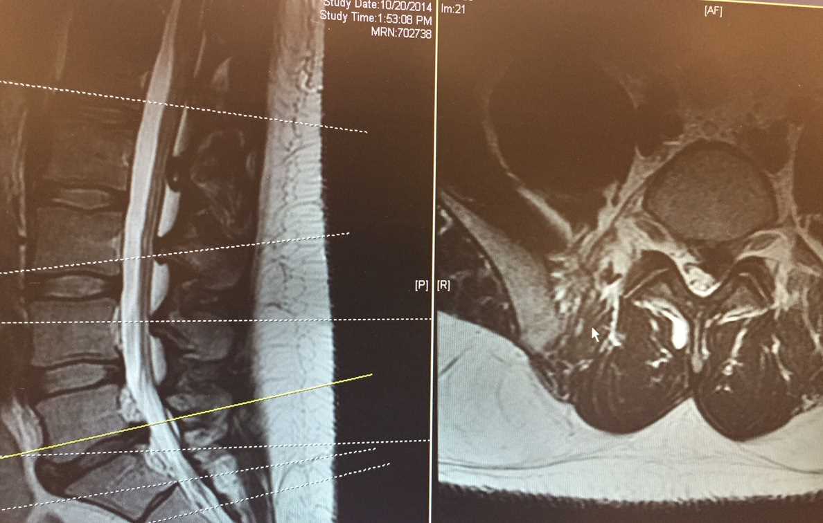 <p>Magnetic Resonance Imaging, Lumbar. The image shows T2-weighted sagittal and axial views of lumbar MRI.</p>