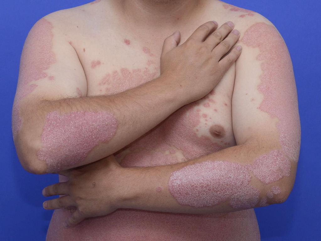 <p>Plaque Psoriasis</p>