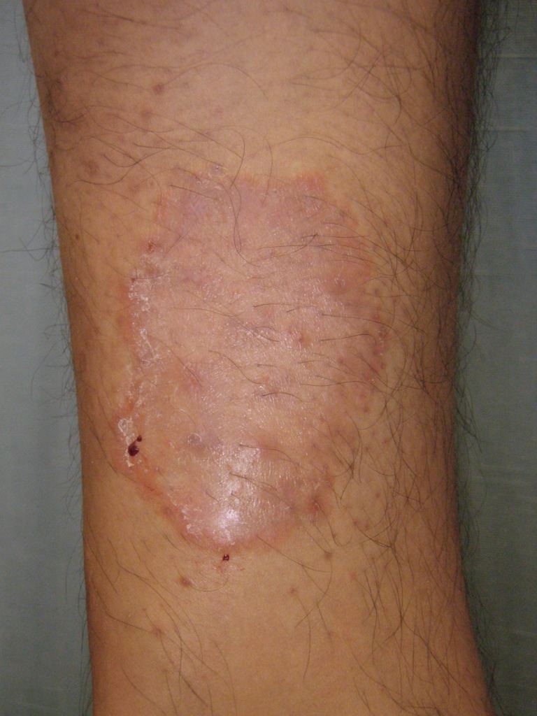 <p>Tinea Corporis</p>