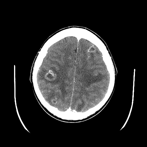 <p>Multiple Brain Abscesses. Axial CT scan of the brain with contrast, revealing the presence of multiple abscesses.</p>