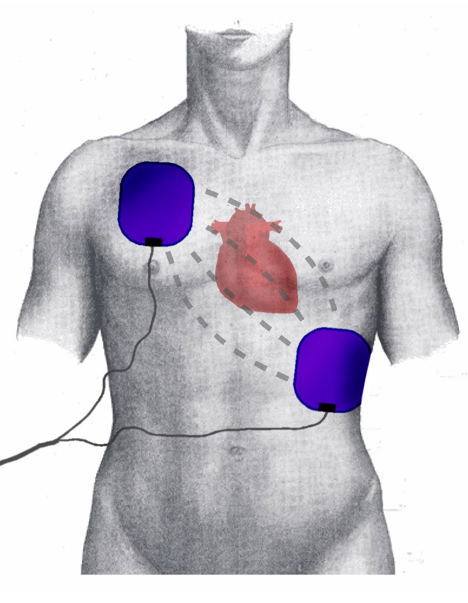 <p>Electrode Positions During Defibrillation/Cardioversion