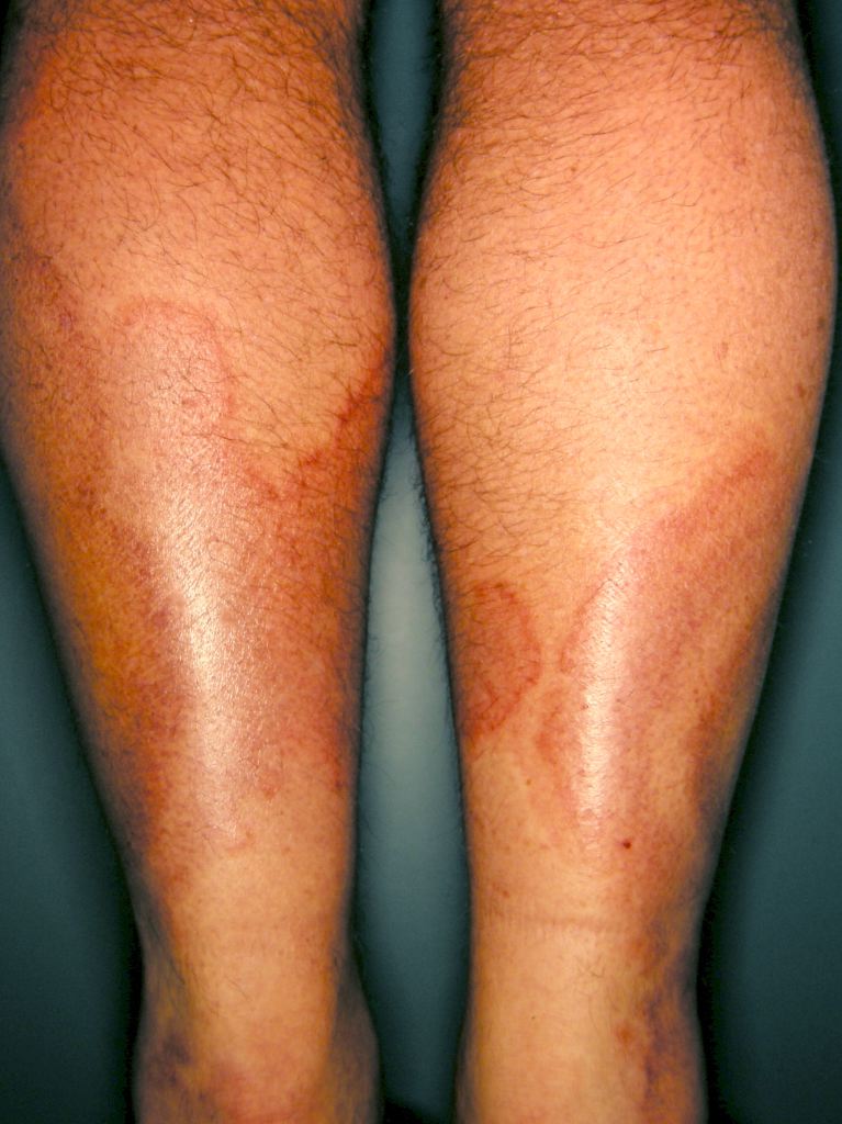 <p>Urticarial Vasculitis</p>