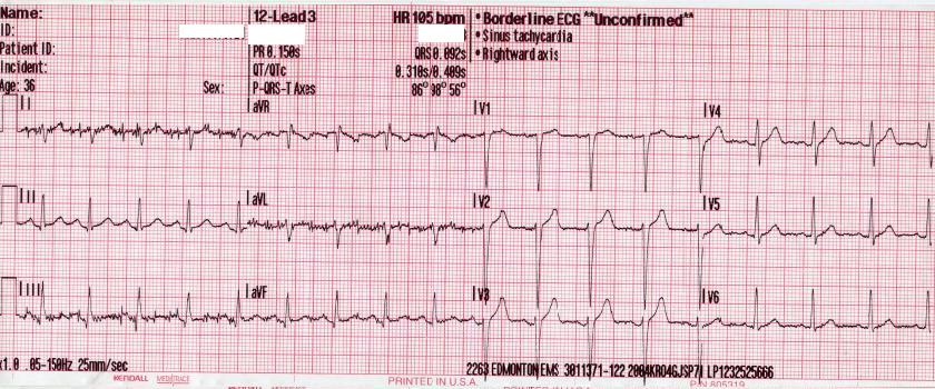 <p>Electrocardiogram, Sinus Tachycardia. Sinus Tachycardia&nbsp;is seen on ECG.</p>