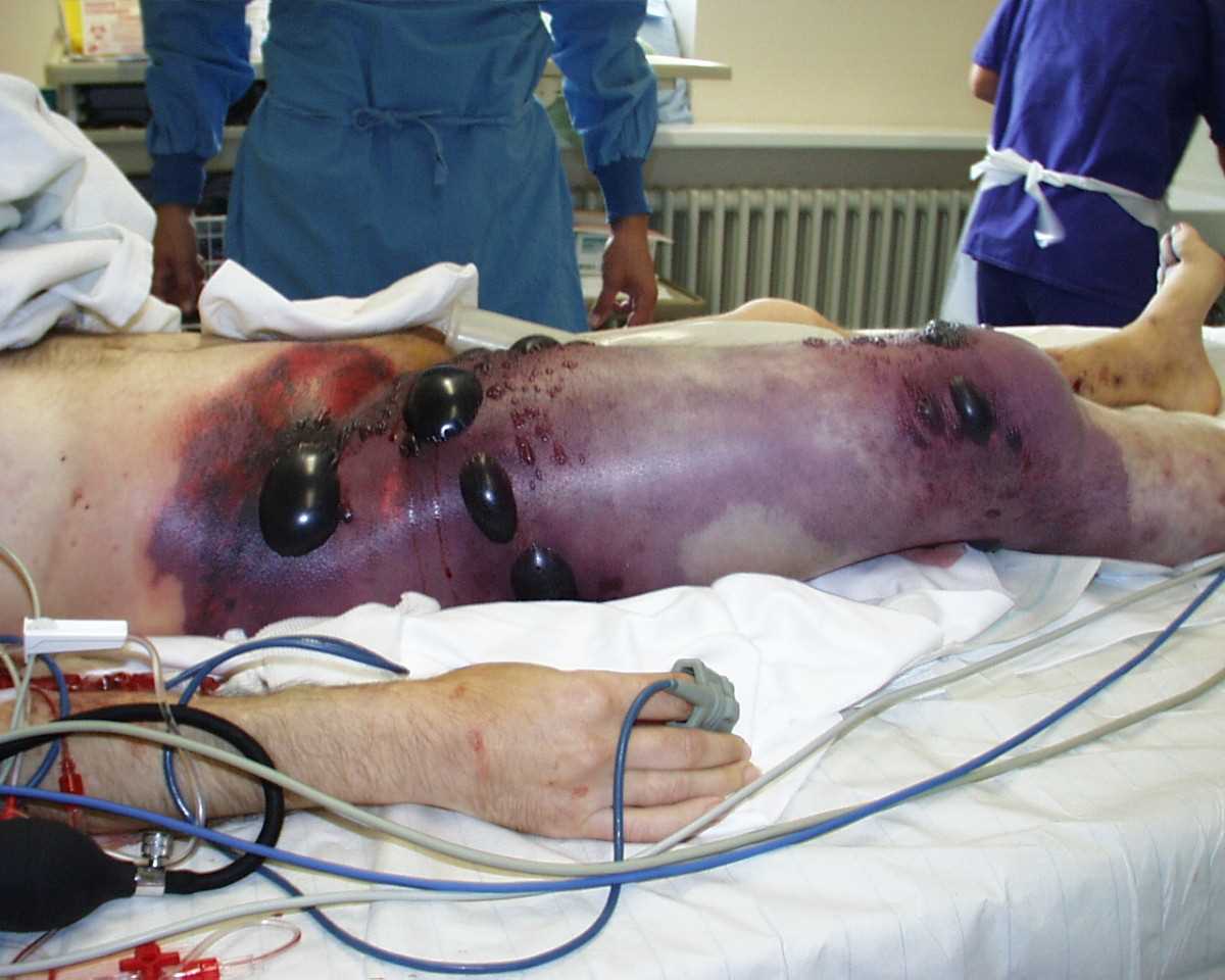 <p>Gas Gangrene of the Right Leg and Pelvis