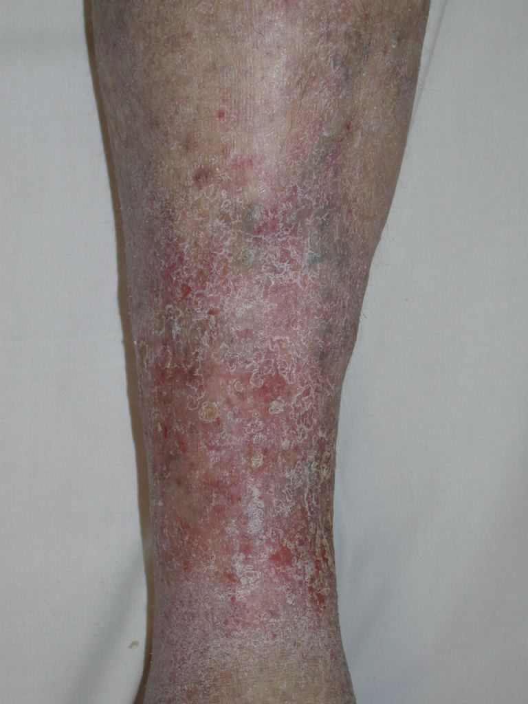 <p>Venous Eczema</p>