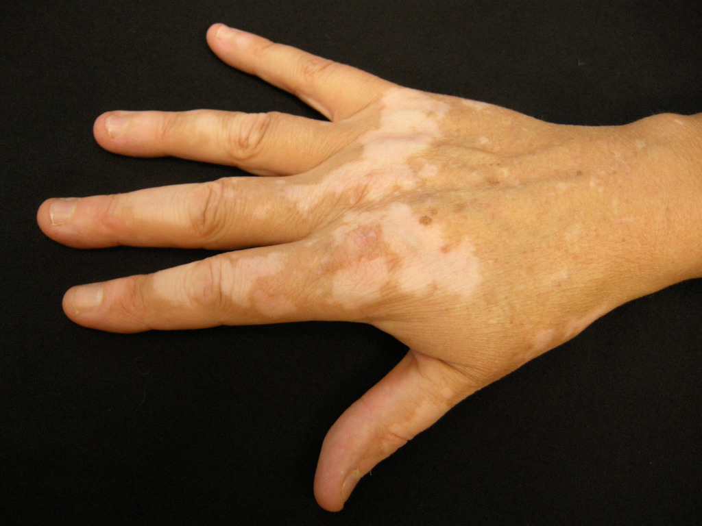 <p>Vitiligo, Hand</p>