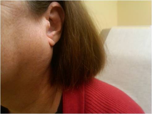<p>Sj&ouml;gren-Related Parotid Disease.</p>