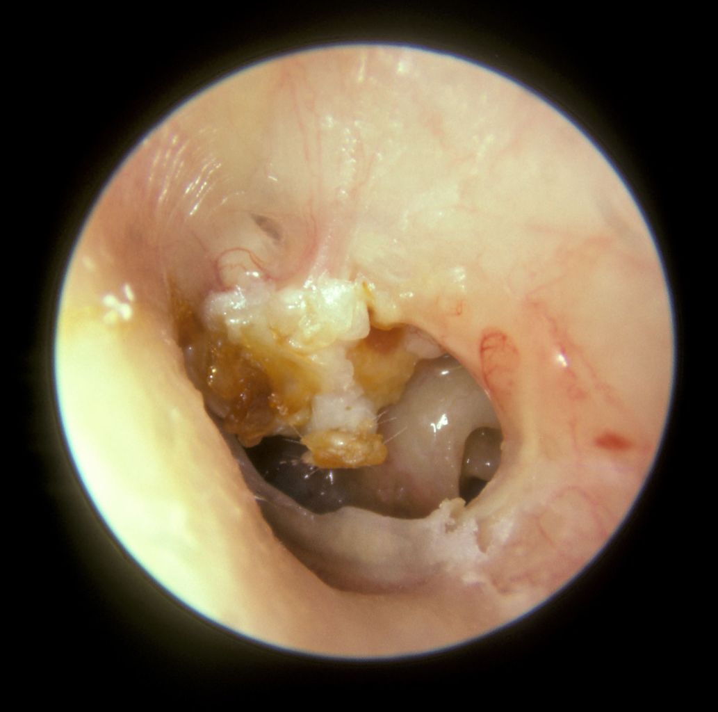 <p>Cholesteatoma in the Left Tympanic Membrane