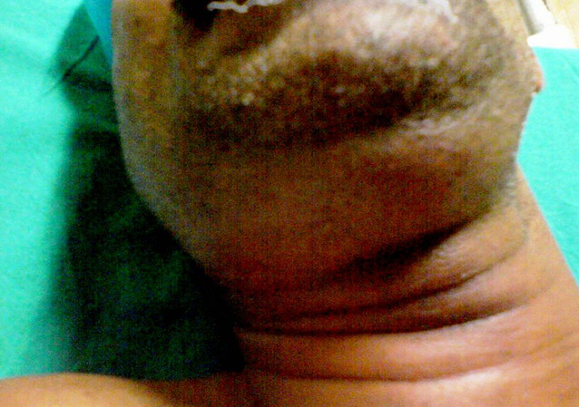 <p>Submandibular Swelling