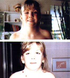 <p>Girl With Turner Syndrome
