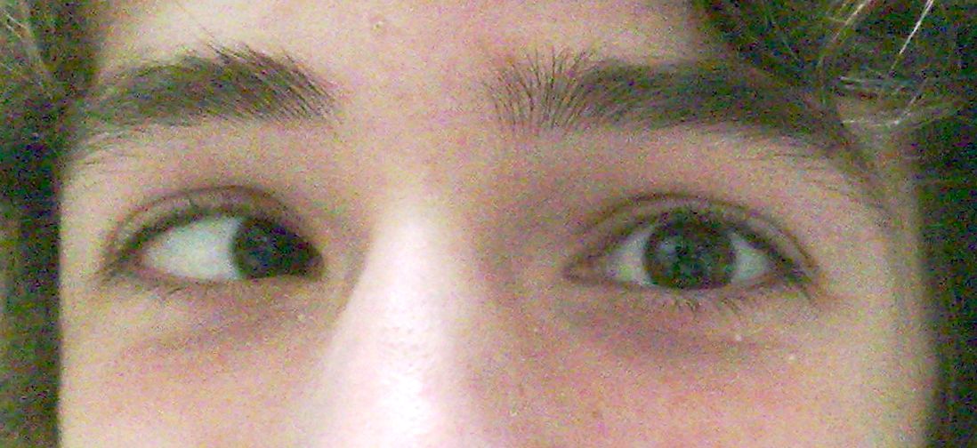 <p>Esotropia of Right Eye</p>