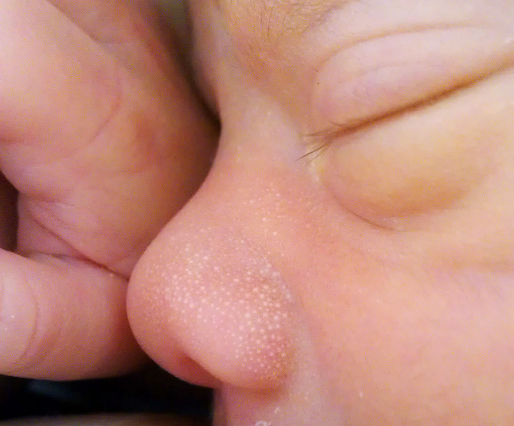 <p>Milia, Milk Spots. Image of milk spots (milia) on the nose of a 1-week-old infant.</p>