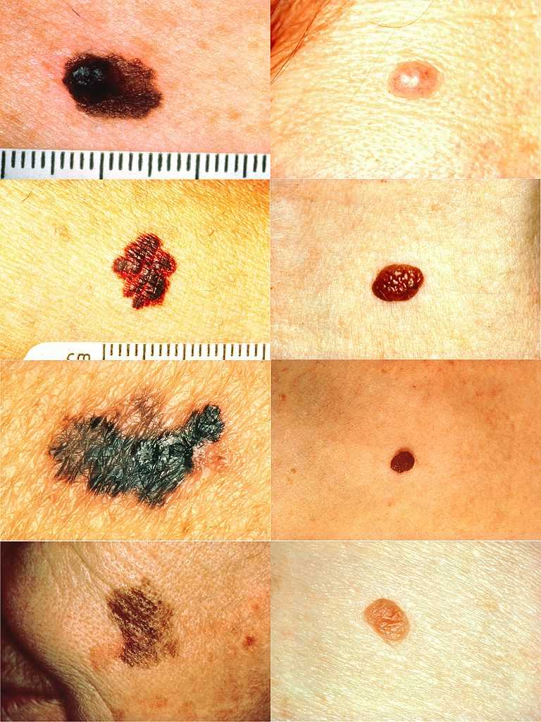 <p>Melanoma Detection