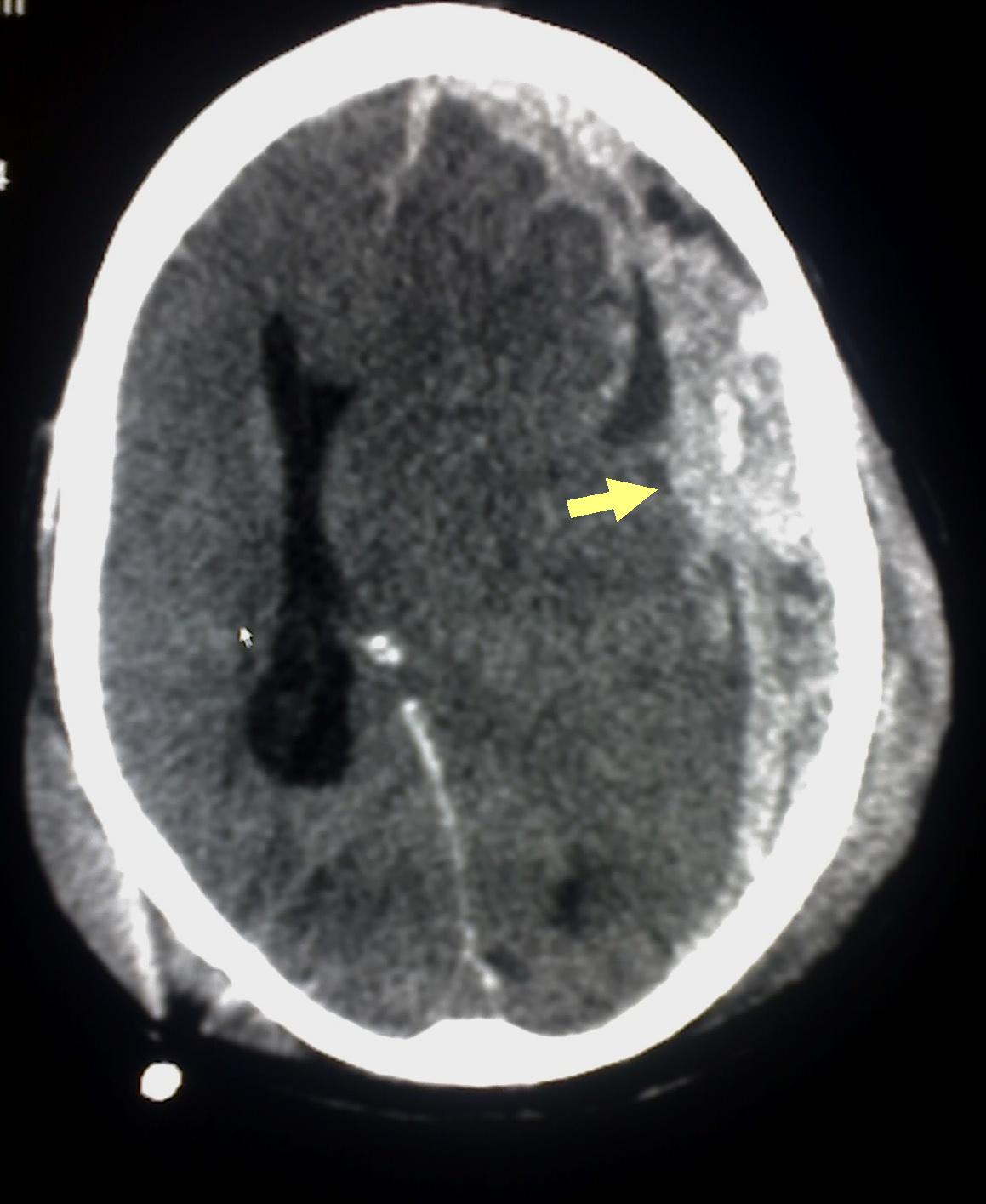 <p>Subdural Hematoma on Computed Tomography