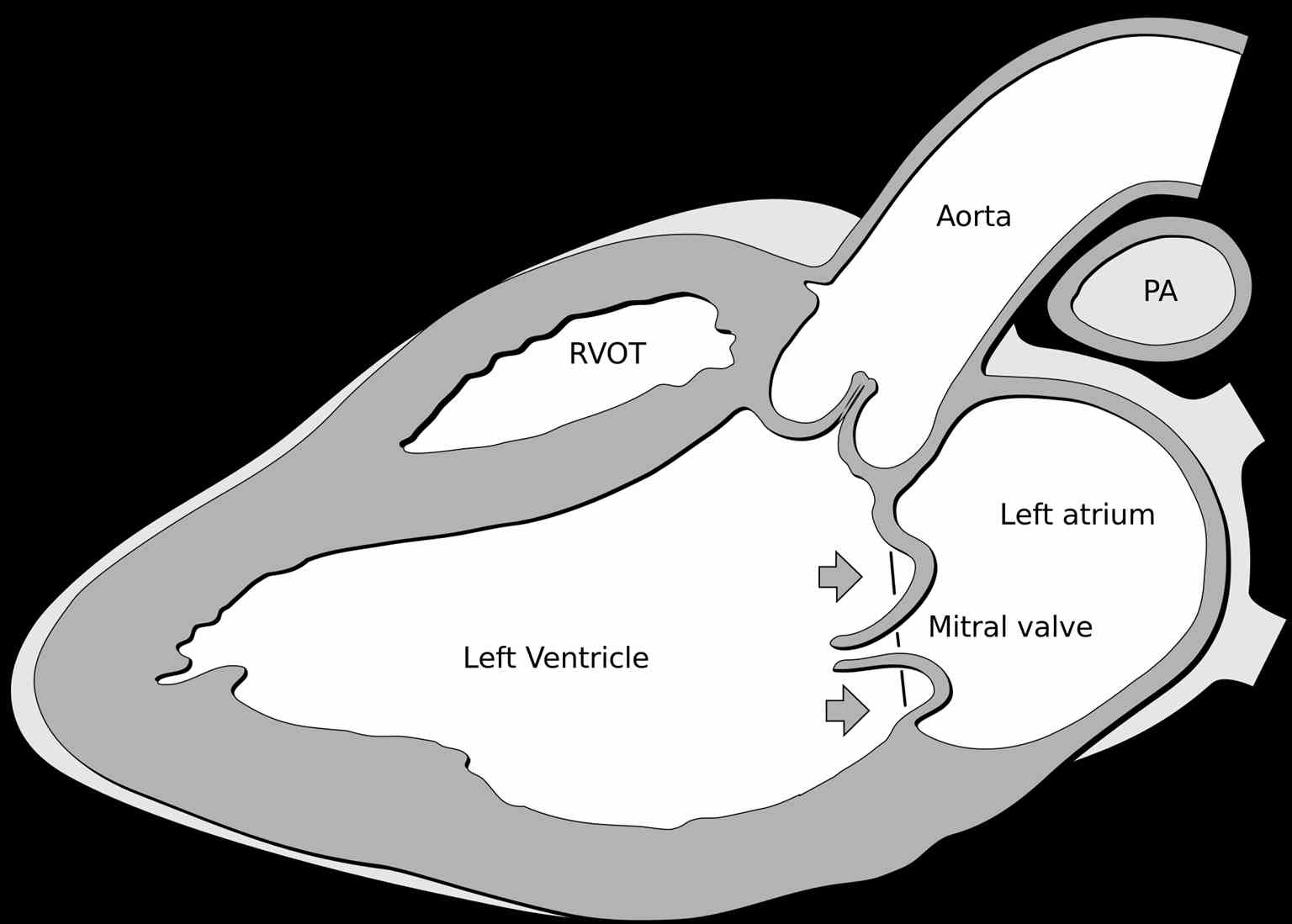 <p>Mitral Valve Prolapse</p>