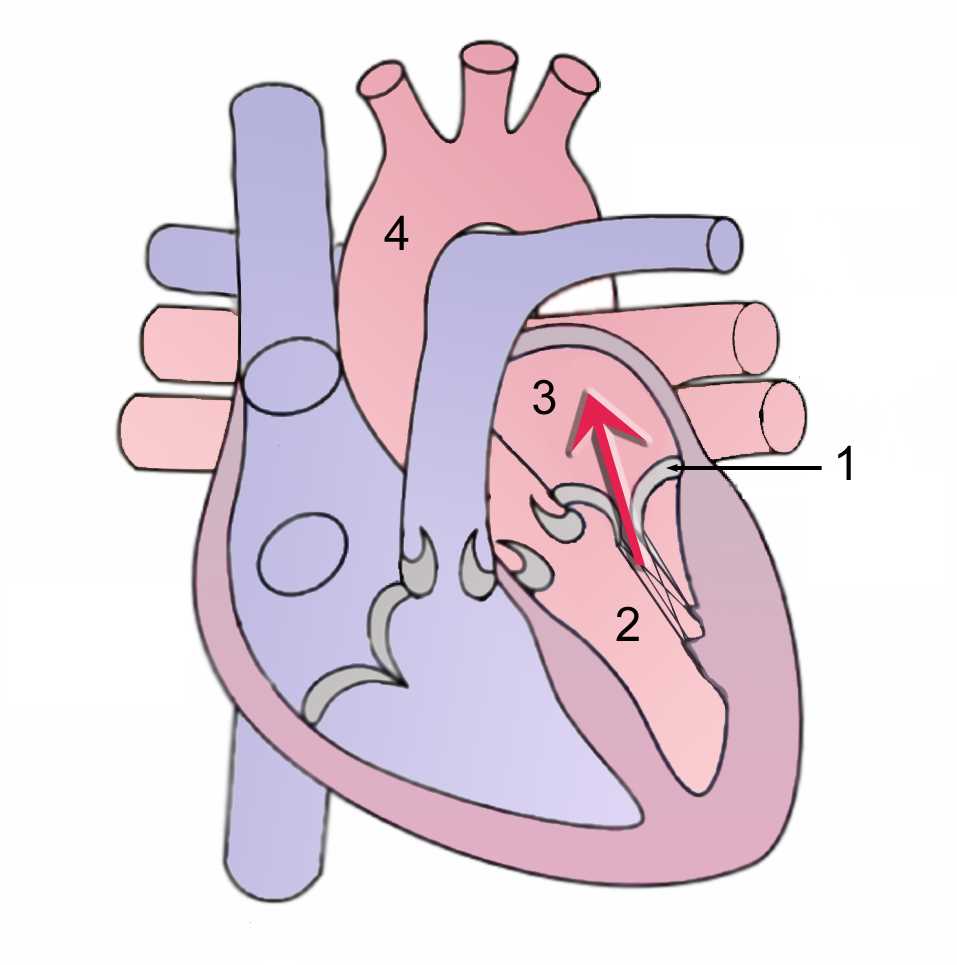 <p>Mitral Regurgitation During Systole