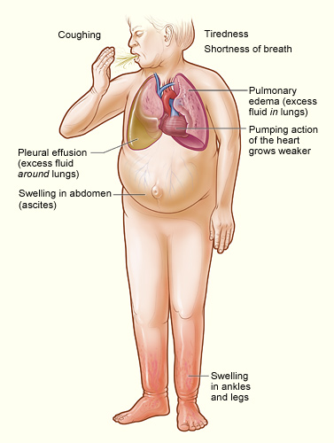 The illustration shows the major signs and symptoms of heart failure.